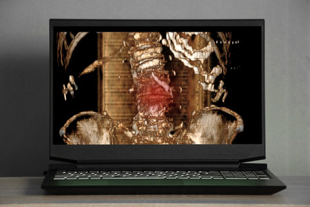 3d computed tomography of the spine with a fracture after injury on laptop screens on the table, the spine after a fall is brokenの写真素材