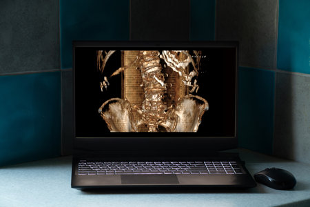 3d computed tomography of the spine with a fracture after injury on laptop screens on the table, the spine after a fall is brokenの写真素材