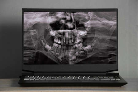 3d computed tomography of the brain with a fracture of the frontal part of the skull after injury on the laptop screens on the table, the skullの写真素材