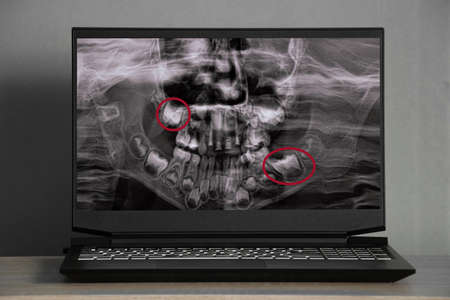 3d computed tomography of the brain with a fracture of the frontal part of the skull after injury on the laptop screens on the table, the skullの写真素材