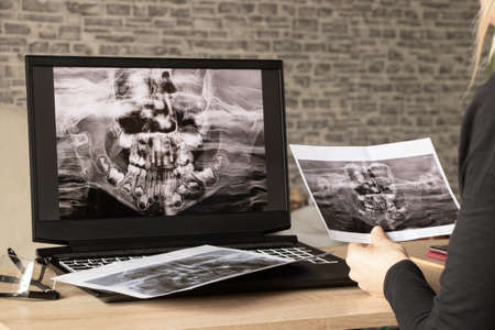 panoramic X-ray of children's teeth of two jaws, orthopantomogram of children's teeth on laptop...