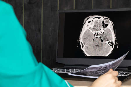 3D computed tomography of the brain with a fracture of the frontal part of the skull after injury on...