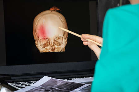 3D computed tomography of the brain with a fracture of the frontal part of the skull after injury on...
