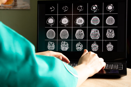 3D computed tomography of the brain with a fracture of the frontal part of the skull after injury on...