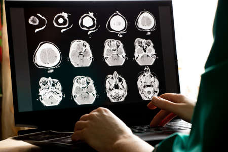 3D computed tomography of the brain with a fracture of the frontal part of the skull after injury on...