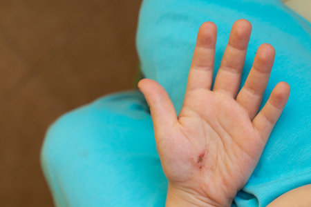 wound on the hand of a little boy after falling close-upの写真素材