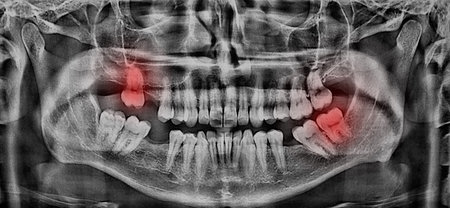 Panoramic dental x-ray for acute pain from wisdom tooth and broken nose, dentistry and diagnostics