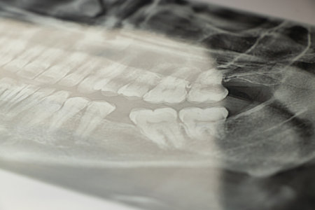 Panoramic dental x-ray for acute pain from wisdom tooth, dentistry and diagnostics