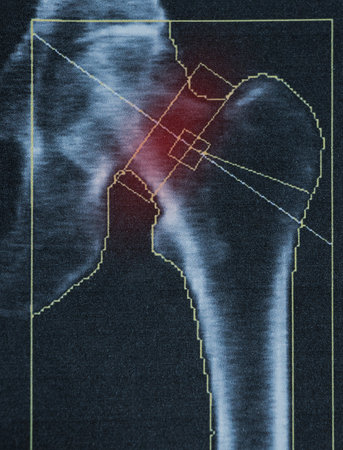 Bone density diagnostics of the femur of an elderly woman with severe osteoporosis, medical...