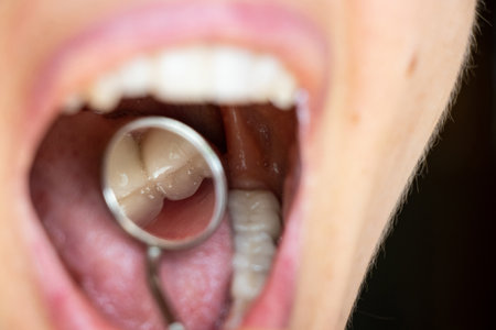 Dental examination in a dentist's mirror, crowns on teeth of a young girlの写真素材