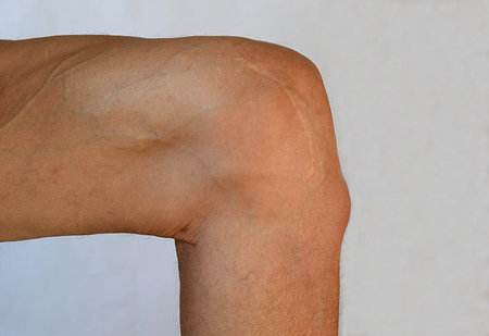 A bump on the leg under the knee joint.