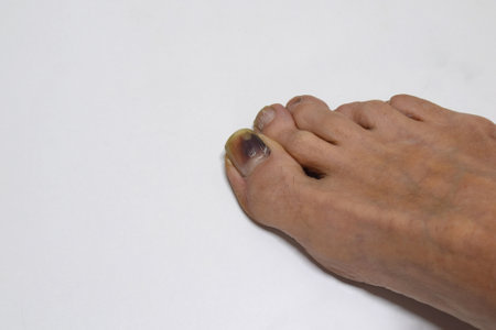 Hemorrhage under the nail on the big toe.