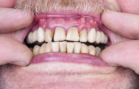 Problems with the teeth and gums concept.  One of the health problems in the elderly. The harm of...