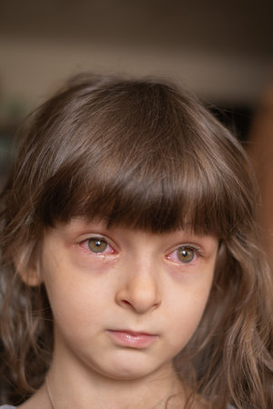 Girl with red eyes with conjunctivitis disease