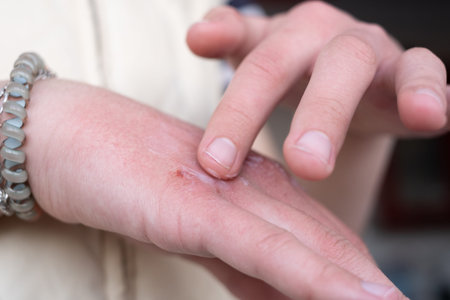 A person is touching their hand where a skin reaction is visible. The area shows signs of irritation...