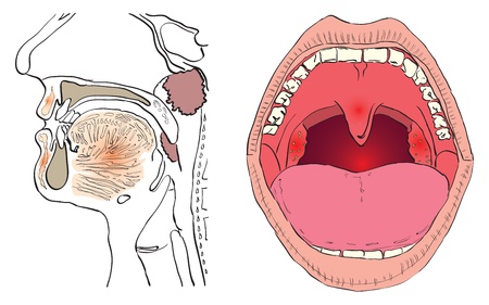 Vector illustration of a disease of the adenoids with the affected agencies.のイラスト素材