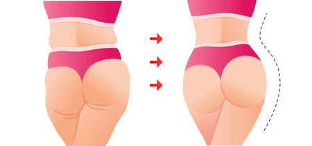 fat to fit body transformation. Woman  before and after diet weigh loss. Fat and slim woman. Plastic surgery. Liposuction. Slim body concept.のイラスト素材