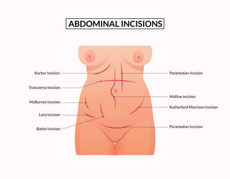 Diagram of Abdominal Hernias Types.のイラスト素材