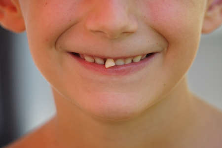 a boy smiling with a incisor milk toothの写真素材