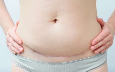 Closeup of woman belly with a scar from a cesarean section on blue background.の写真素材