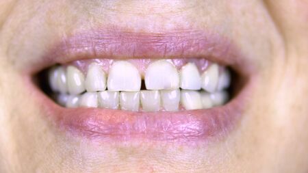 Old woman shows teeth. The upper teeth are straight and the lower crooked. close-up