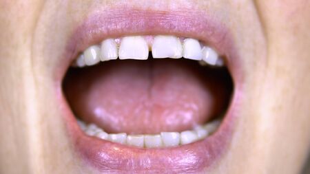 Old woman shows teeth. The upper teeth are straight and the lower crooked. Woman opened her mouth....