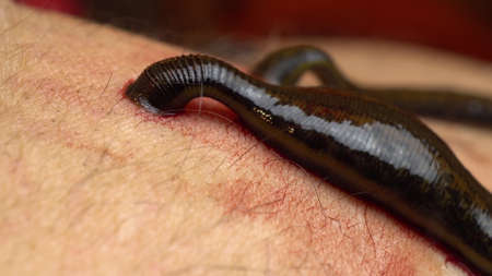 Medical leeches on the human body drink blood. Treatment with leeches. Macro video.の写真素材