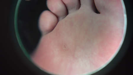 A magnifying glass zooms in on a wart on a girls leg in a podiatrists salon. View of the leg through a large magnifying glass.の写真素材