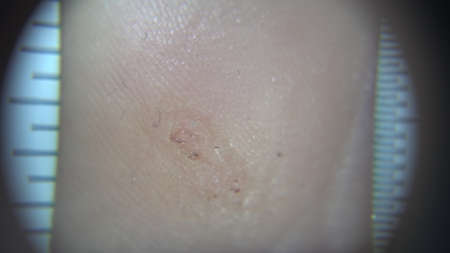 An electron microscope zooms in on a wart on a girls leg in a podiatrists salon. View of the leg through a microscope.の写真素材