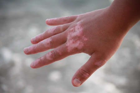Vitiligo on the hand on the sea background.