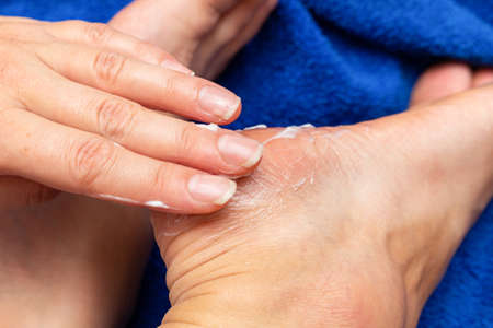 applying cream on the feet sole for the treatment of corn, callus, callosity, cracks, softening the skin, cosmetic proceduresの写真素材
