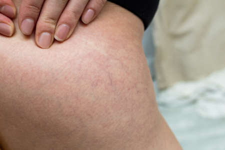 Varicose veins on a womanâ€™s hip after childbirth