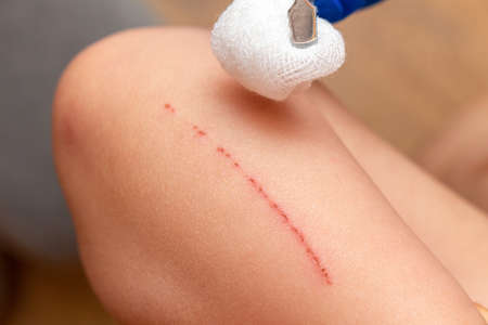 treating scratches on a childâs hand with a cotton swabの写真素材
