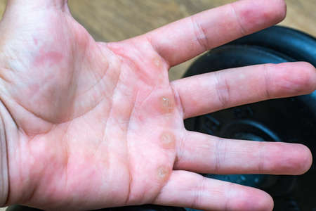 Hand with corn, callus, callosity, induration, congelation on the palm because of physical activity sportsの写真素材