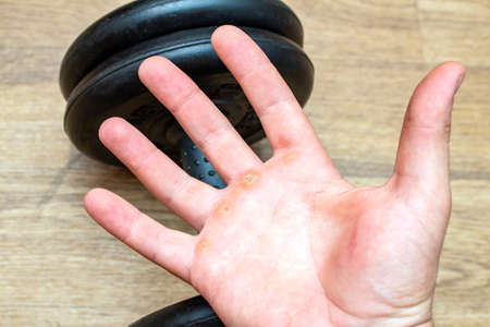 Hand with corn, callus, callosity, induration, congelation on the palm holding dumbbell physical...