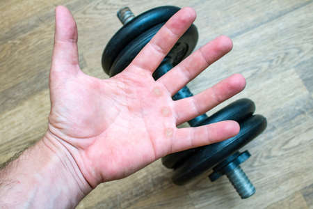 Hand with corn, callus, callosity, induration, congelation on the palm holding dumbbell physical...