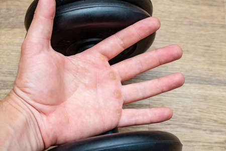 Hand with corn, callus, callosity, induration, congelation on the palm holding dumbbell physical activity sports gym sport conceptの写真素材