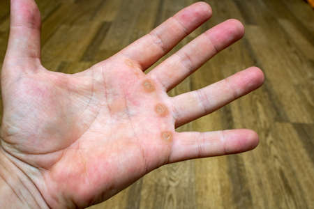 Hand with corn, callus, callosity, induration, congelation on the palm because of physical activity...