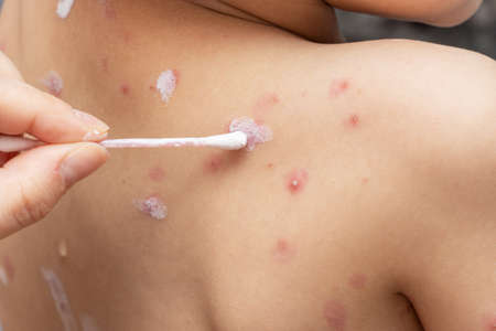 treatment of ulcers from chickenpox, varicella with medical cream on the kid skin