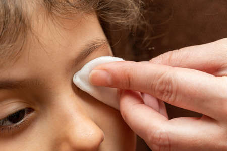 treatment of sick, red child eye with conjunctivitis, with a cotton swab