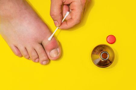 Gout on the big toe treatment with therapeutic ointment, top view