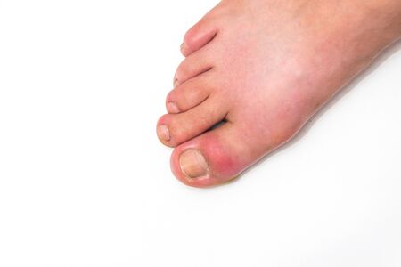 Gout or podagra on the big toe appears as redness and unbearable painの写真素材