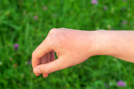 A red hot sun allergy spot on the arm is usually painful or itchy.の写真素材