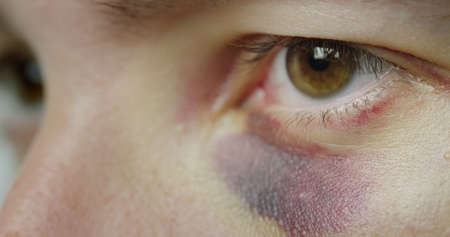 The eye of a man with a bruise and abrasionsの写真素材