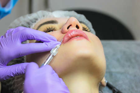 Lip augmentation procedure. A beautiful patient woman getting filler injection, botox. A beautician injects collagen, hyaluronic acid, silicone through a syringe. A beautician wearing purple glovesの写真素材