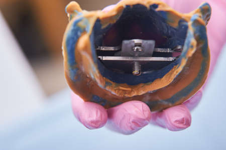 Dental surgery. Dental technician making dentures. Dental prosthesis in medical hands before prosthetics work.の写真素材