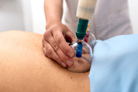 Stock photo of unrecognized man receiving cupping treatment on her back while lying on stretcher.