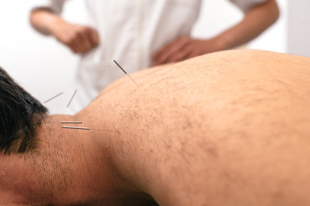 Stock photo of unrecognized worker doing acupuncture procedure to male client.の写真素材