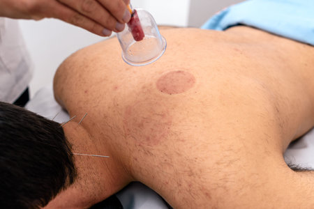 Stock photo of unrecognized man receiving cupping treatment on her back while lying on stretcher.