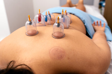 Stock photo of unrecognized woman receiving cupping treatment on her back while lying on stretcher.の写真素材